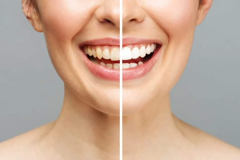 How To Find Teeth Whitening In Bristol What To Look For And What To Avoid