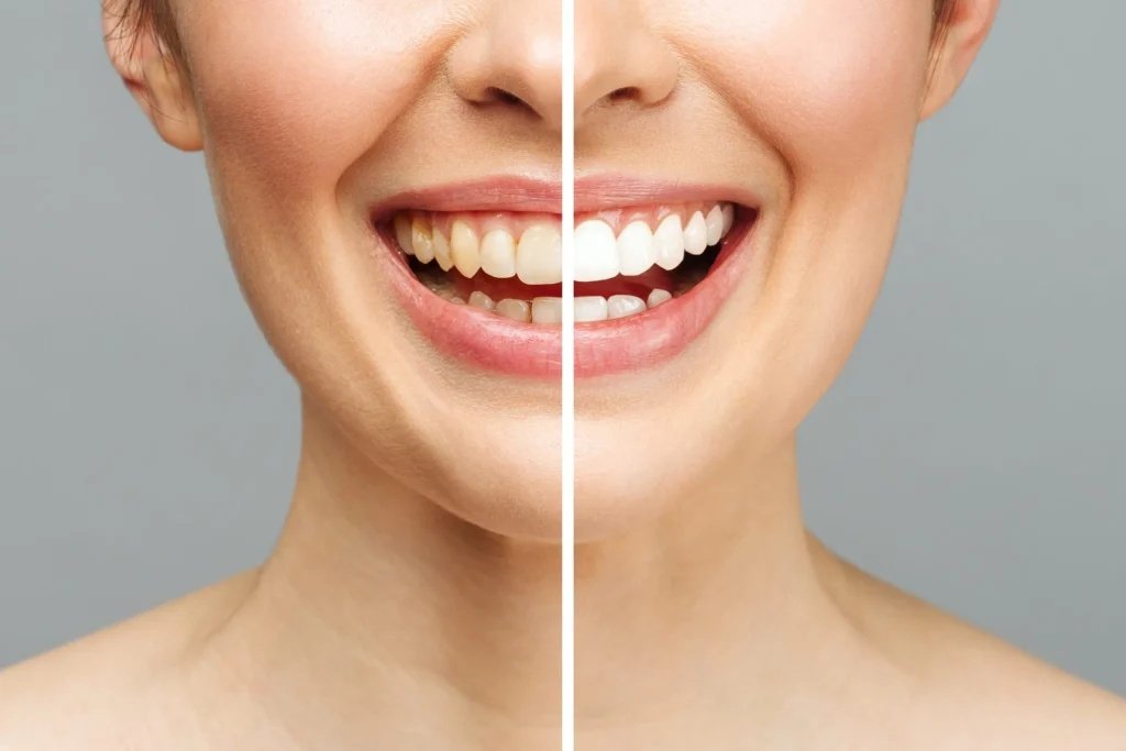 How To Find Teeth Whitening In Bristol What To Look For And What To Avoid